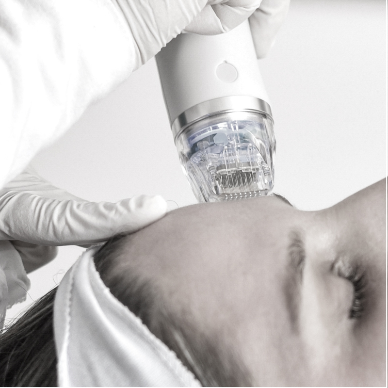 Rf Microneedling for Scars/ Rejuvenation of Skin process by Dr Sarah Naeem